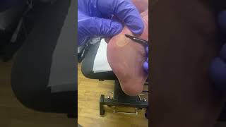 Watch a Podiatrist Remove Corn and Calluses with Ergonx and Docpods for Healthy and PainFree Feet [upl. by Taite]