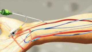 Radial artery puncture using the Insyte and Angiocath technique [upl. by Egide]