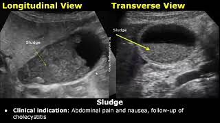 Gallbladder Ultrasound Reporting  GB Disease Scan Reports  How To Write USG Report  Abdominal USG [upl. by Beata]