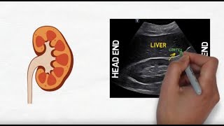 Hydronephrosis on kidney ultrasound [upl. by Erehc]