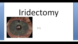 Ophthalmology Iridectomy Indications Procedure Surgical Iridotomy Difference [upl. by Ayekim]