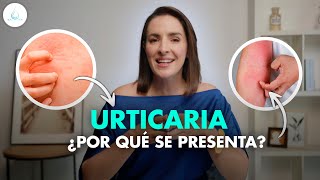 🔴 URTICARIA  Que es Sintomas y tratamiento drapilarochoa  Dermatologa [upl. by Ahsirat113]