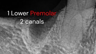 Endodontic treatment Lower premolar 2 canals [upl. by Ydnagrub55]