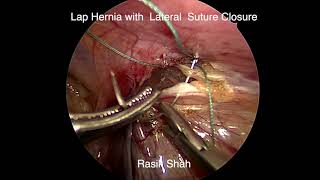 LAPAROSCOPIC REPAIR OF INGUINAL HERNIA WITH LATERAL SUTURE CLOSURE IN A 12 YEAR OLD BOY [upl. by Ikila]