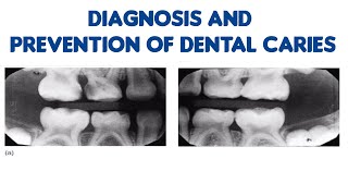 Diagnosis and prevention of Dental caries [upl. by Gunning]