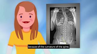 What is scoliosis [upl. by Esela]