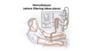 Dialysis Access and Fistula Procedure [upl. by Yrebmik389]