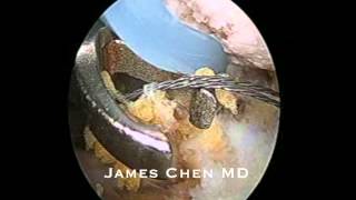 Arthroscopic AC Joint Reconstruction with Allograft [upl. by Idnem877]