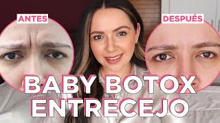 Baby Botox entrecejo para PREVENIR arrugas [upl. by Yanetruoc]