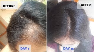 OMG  15 Days Hair Growth Miracle Treatment  Grow Long Thicken Hair  100 works [upl. by Noet]