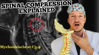 Spinal Cord Compression [upl. by Attevaj]