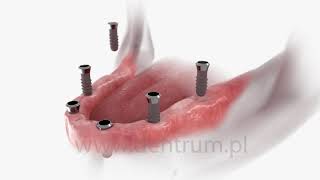Proteza zębowa na 6 implantach [upl. by Kellyann]