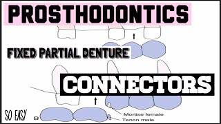 CONNECTORS II RIGID AND NON RIGID II FIXED PARTIAL DENTURE II PROSTHODONTICS [upl. by Enitnelav]