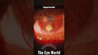 Fungal keratitis [upl. by Beichner]