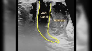 perianal abscess [upl. by Ahsilla734]