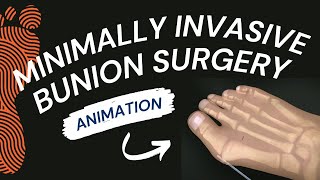 Minimally Invasive Bunion Surgery A Short Animation [upl. by Nunci194]