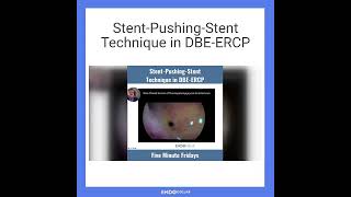 StentPushingStent Technique in DBEERCP [upl. by Analad]