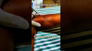 Picosecond Laser tattoo removal [upl. by Seabury]