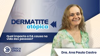 Dermatite Atópica no Fantástico  Qual impacto da DA na vida das pessoas Com Dra Ana Paula Castro [upl. by Etteroma322]