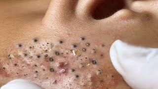 Big Cystic Acne Blackheads Extraction Blackheads amp Milia Whiteheads Removal Pimple Popping  3435 [upl. by Richia]