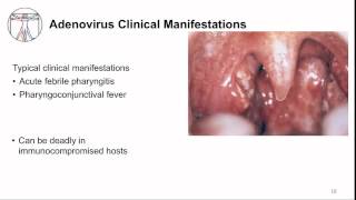 Respiratory Viruses Upper Respiratory Tract [upl. by Dobb]