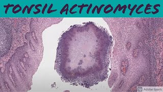 Tonsil Actinomyces 5Minute Pathology Pearls [upl. by Dnalrag113]