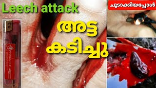 അട്ട കടിച്ചു  atta kadichu  Leech attack atta treatment malayalam atta atta atta leech [upl. by Wohlen]