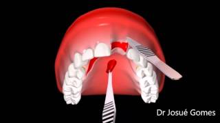 Enxerto de gengiva antes da instalação de implante dentário [upl. by Ime]