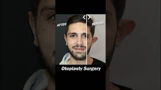 Otoplasty Surgery earsurgery [upl. by Needan]