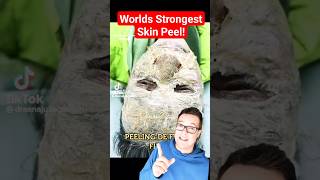 WORLDS STRONGEST SKIN PEEL  Phenol Peel Process shorts [upl. by Carmelina629]