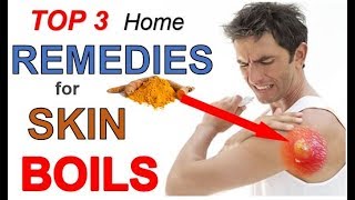 5 Quick Ways to GET RID OF Boils on Skin  How to Treat a Boil Fast [upl. by Ahsiyn490]