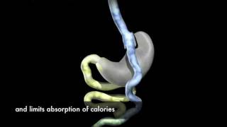 Laparoscopic RouxenY Gastric Bypass Surgery Animation [upl. by Neelat60]