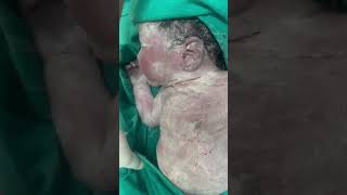 Vernix caseosa a protective sensitive newborn skinnewborn baby ❤️ [upl. by Midian]