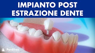 Impianto dentale immediato postestrazione dente © [upl. by Ragan]