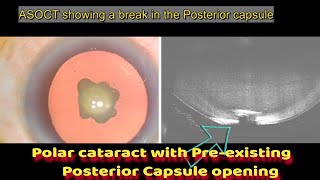 Best Video Posterior Polar cataract with Pre existing Capsular opening  using D segment side chop [upl. by Einned]