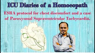 ESRA protocol for chest discomfort  Case of Paroxysmal Supraventricular Tachycardia [upl. by Swartz]