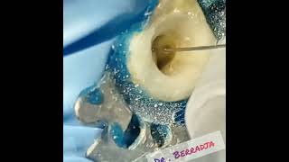 traitement endodontique sur molaire mandibulaire inférieure [upl. by Conner601]