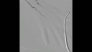 Heberdens nodes angiography [upl. by Aisetra]