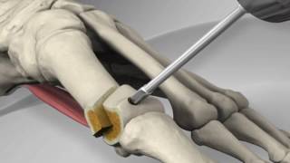 First Metatarsal Distal Chevron Osteotomy with Arthrex® LPS Screw [upl. by Thomas21]