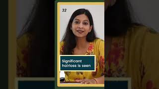 Telogen Effluvium  Sudden amp Severe hairfall  Dr Sanchika Gupta 👩‍⚕️ [upl. by Tenneb590]