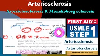 Arteriosclerosis Arteriolosclerosis vs Monckeberg sclerosis in HindiUrdu by first aid for step 1 [upl. by Aivatnwahs153]