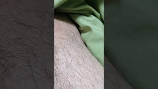 Lyme disease muscle fasciculations lyme [upl. by Acisse83]