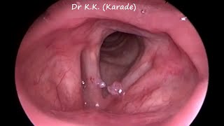 Video Laryngoscopy  How Vocal Polyp Look Like [upl. by Gerhardine]