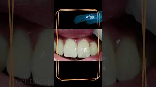 teeth gap  teeth gap filling  Composite filling [upl. by Kendrick]