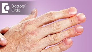 What causes painful horizontal ridges on nails with discomfort  Dr Urmila Nischal [upl. by Oidacra888]