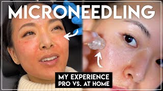 MY MICRONEEDLING EXPERIENCE Both Pro amp AtHome Treatments [upl. by Nairot]