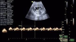 ECOGRAFÍA DE 11 SEMANAS DESCARTANDO PATOLOGIA CARDÍACA [upl. by Amlet468]