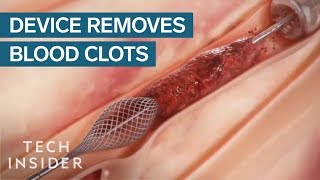 How This Device Safely Removes Blood Clots  Tech Insider [upl. by Severson]