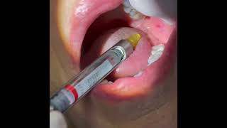 Dental Anaesthesia inferior alveolar nerve block [upl. by Levram975]