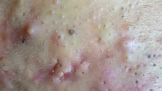 Make your Acne Treatment Huong Da Nang  448 Hoang Part 1  acne 2022 [upl. by Nylodnew297]